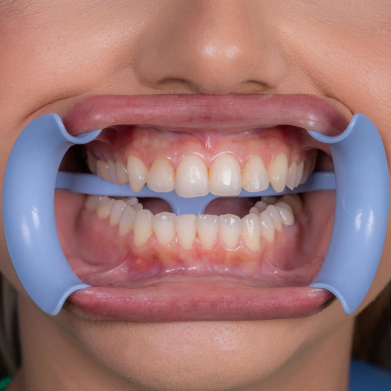 Retractor Frontal Lip Expand Blanco Adulto 1 Un. Indusbello - Imagen 4